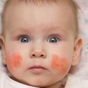 Chàm da ở trẻ nhỏ – bệnh gây mẩn ngứa khó chịu cho bé và cách khắc phục